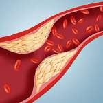 THỰC ĐƠN DÀNH CHO NGƯỜI BỊ BỆNH MỠ MÁU